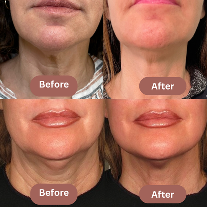 The Elevé Face Shaper