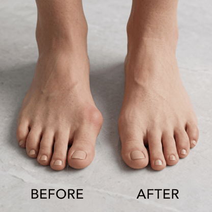 HalluxAlign – Fini les douleurs, place au réalignement naturel sans chirurgie.